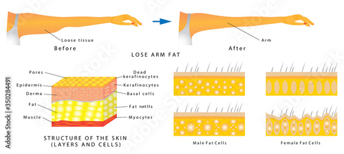 Lose arm fat. Subcutaneous fat distribution in human. Anatomy of Human Skin layer and arm. Women with arm imbalance of body fat.