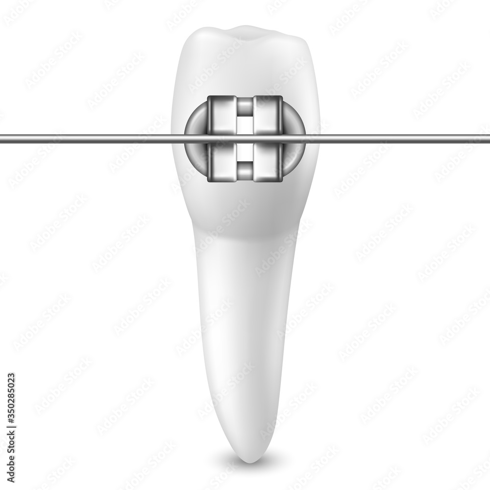 Vector 3d Realistic Tooth with Braces Icon Closeup Isolated on White ...