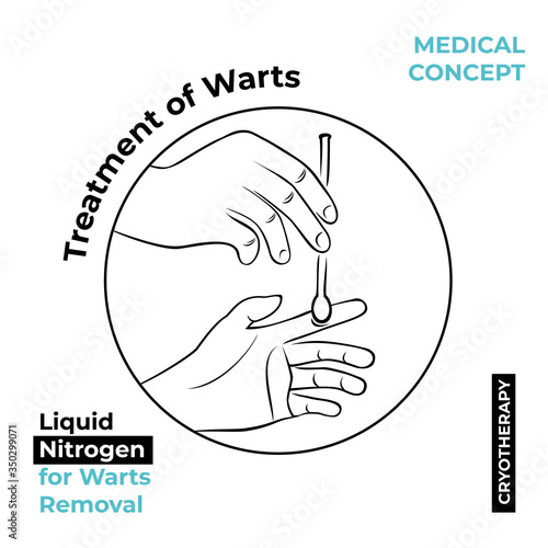 Round icon about the treatment of warts. Burning a wart with liquid nitrogen. A hand holds a stick with nitrogen and burning a wart on his hand