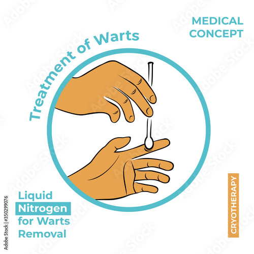 Round icon about the treatment of warts. Burning a wart with liquid nitrogen. A hand holds a stick with nitrogen and burning a wart on his hand