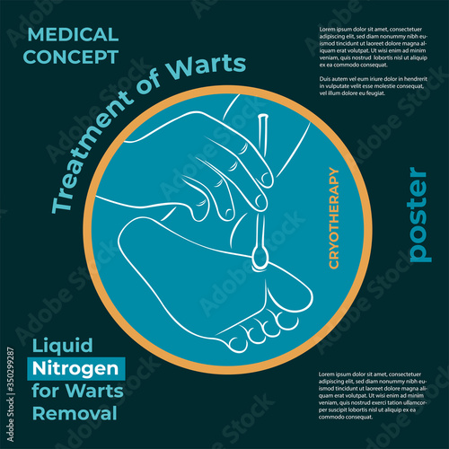 Medical poster. Round icon about the treatment of warts. Burning a wart with liquid nitrogen. A hand holds a stick with nitrogen and burning a wart on his leg