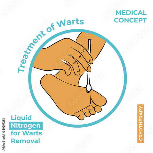 Round icon about the treatment of warts. Burning a wart with liquid nitrogen. A hand holds a stick with nitrogen and burning a wart on his leg