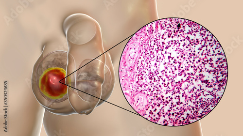 Testicular seminoma, germ cell tumor of the testis photo