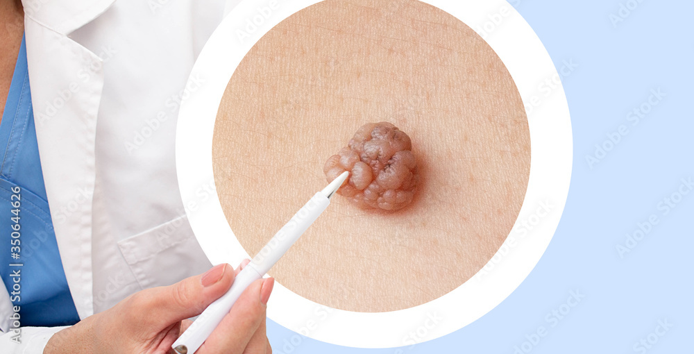 Dermatology, close up mole, cancer prevention. Observation of moles