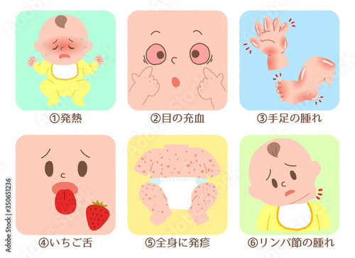 赤ちゃん　川崎病　症状　セット