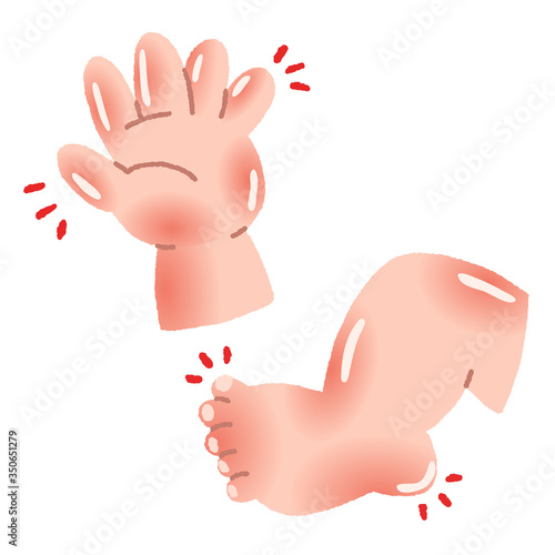 赤ちゃん　手足の腫れ　川崎病