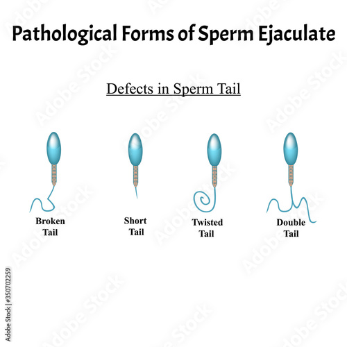 Pathological forms of sperm in the ejaculate. Male infertility Oligospermia. Spermogram. Pathology of the tail. Sperm defects. Infographics. Vector illustration on isolated background.