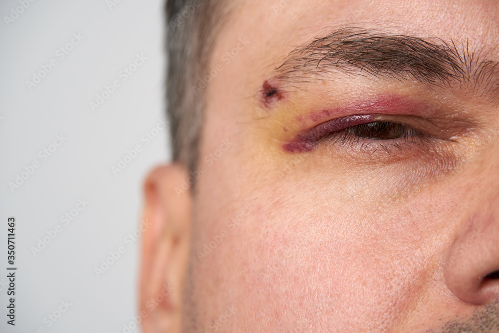close view of a bruise near the eye, the face of a man with a hematoma close view of a bruise near the eye, the face of a man with a hematoma