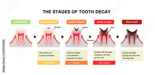 The stages of tooth decay / flat vector illustration
