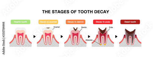 The stages of tooth decay / flat vector illustration
