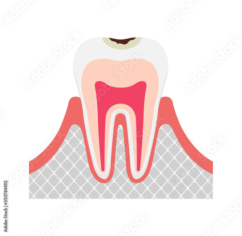 The stage of tooth decay / Decay in enamel