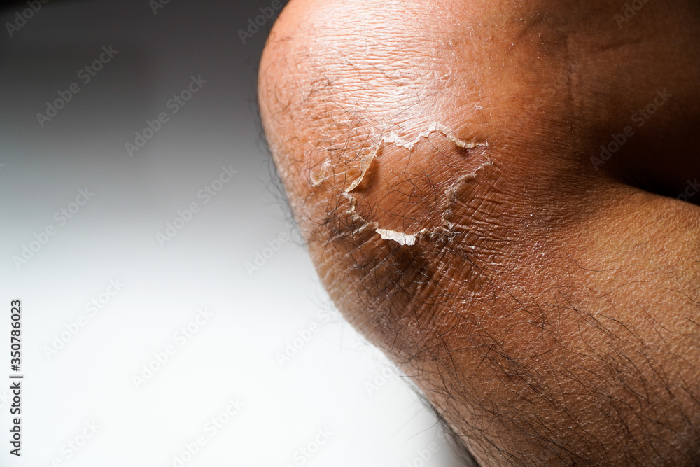 Fototapeta premium Peeling the skin on the knees