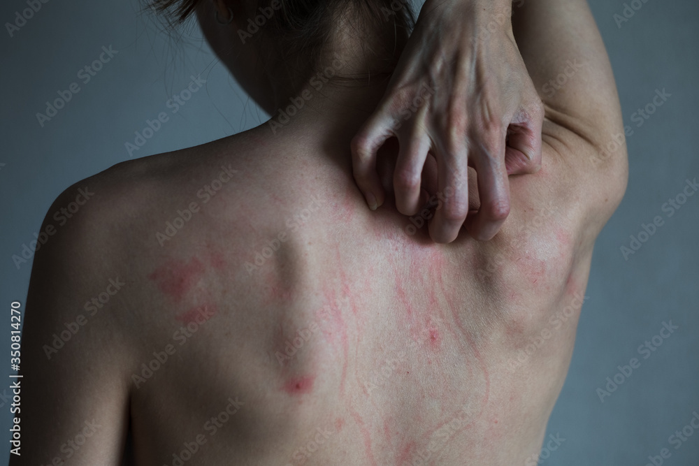 Rear view - Female hand scratching her irritation back. Concept neurotic disorder, mental illness of self-harm. Rear view - Female hand scratching her irritation back. Concept neurotic disorder, mental illness of self-harm.