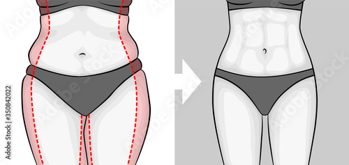 The body of a woman before and after losing weight. Press and hips. Red outline showing excess weight.
