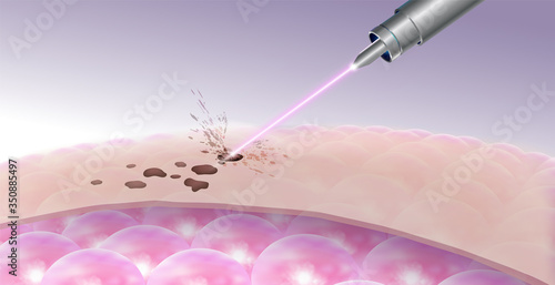 Details for laser freckles and dark spot removal On the upper skin Does not affect the cells under the skin. Realistic file.