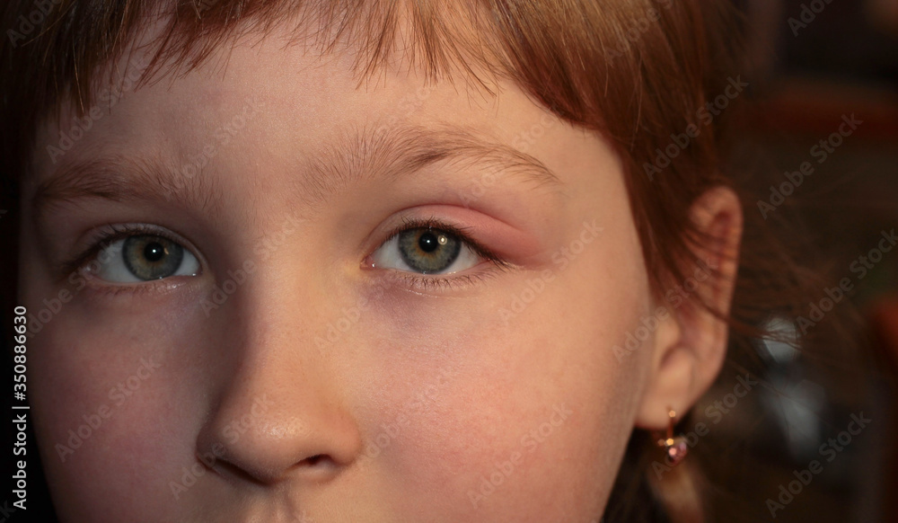 Barley in the eye. A child with barley in his eye. Inflammation of the eyelid. Human disease. Barley in the eye. A child with barley in his eye. Inflammation of the eyelid. Human disease.