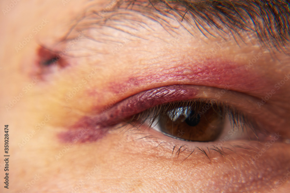 Obraz premium close view of a bruise near the eye, the face of a man with a hematoma