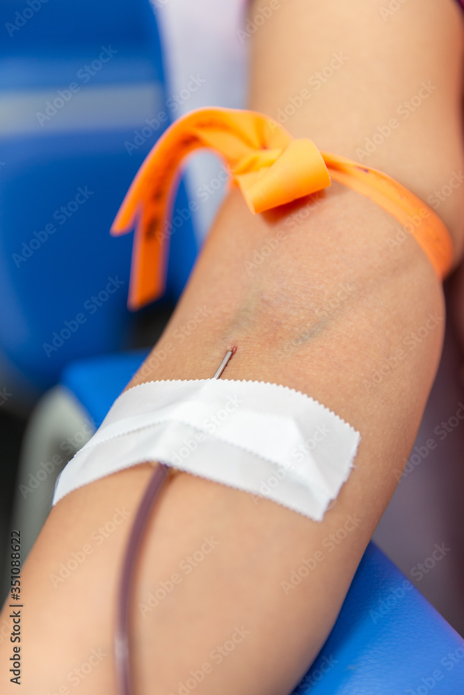 Close up shot of blood donation with needle (catheter) in the arm with a tourniquet and visible veins.
