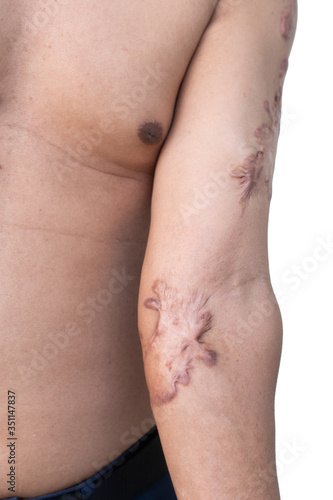 scar on his arm, scar from car accident on man body isolated on white background