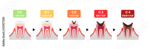 虫歯の進行と症状　イラスト