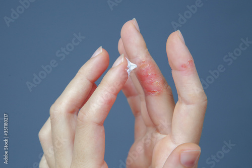 Atopic hand dermatitis. Eczema on the fingers.  photo