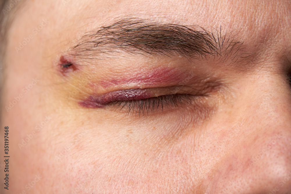 close view of a bruise near the eye, the face of a man with a hematoma close view of a bruise near the eye, the face of a man with a hematoma
