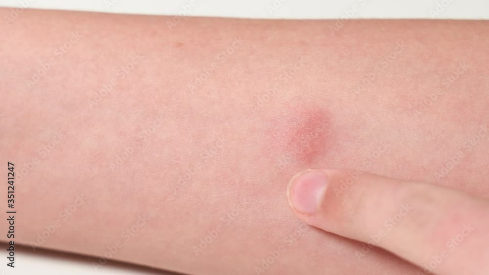 Closeup view 4k video of child hand with red spot reaction to conducting Mantoux test after 72 hours from injection. Kid touching place of injection with finger. Closeup view 4k video of child hand with red spot reaction to conducting Mantoux test after 72 hours from injection. Kid touching place of injection with finger.