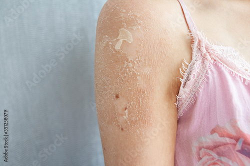 Close up of Eczema (Dermatitis), Allergy, Fungal, Psoriasis, Dry or Burned skin. Close up of the Shoulder.
Health care concept.
