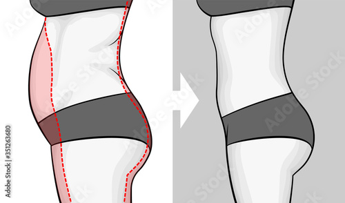 The body of a woman before and after losing weight. Belly view from side. Red outline showing excess weight.