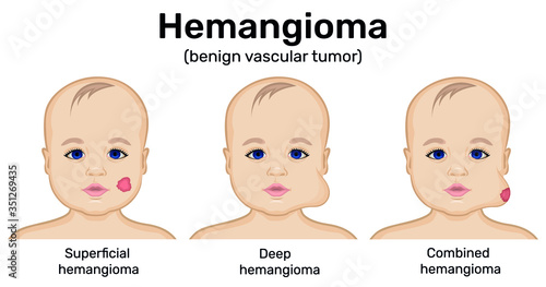 Illustration of a benign tumor of infantile hemangioma photo