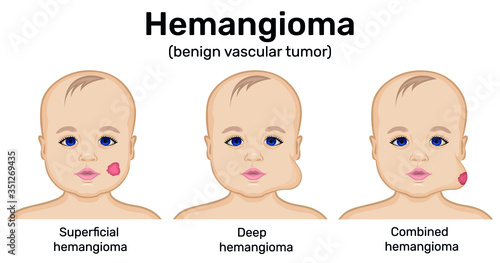 Illustration of a benign tumor of infantile hemangioma