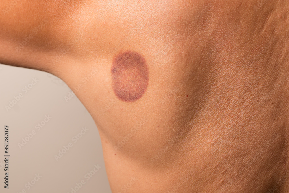 Fototapeta premium Patient that had cupping therapy done on his upper back 