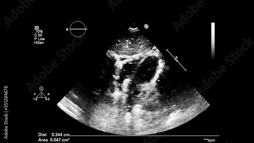 Image of the heart in gray-scale mode during transesophageal ultrasound.