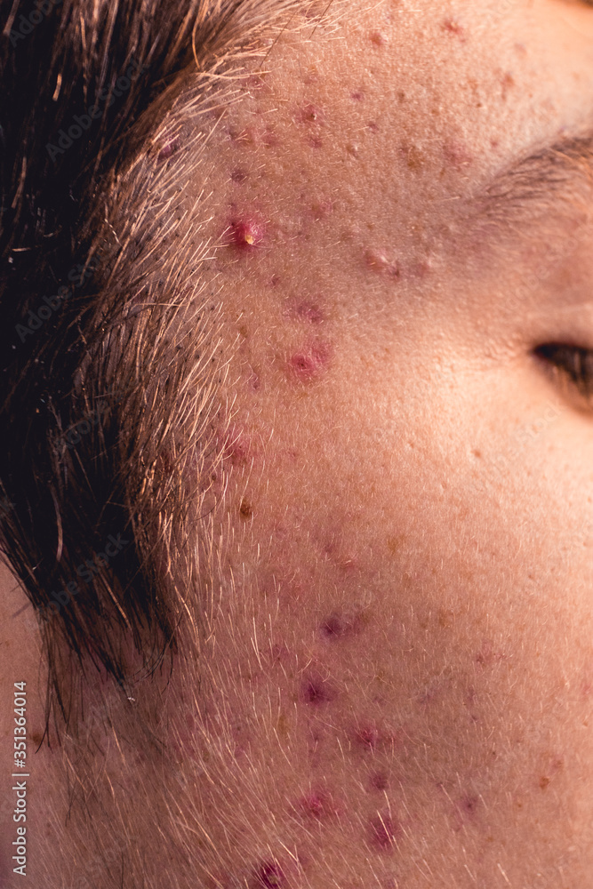 Young face with acne