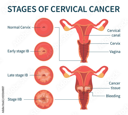 Flat vector illustration of stages of cervical cancer including normal, early, late stage IB and stage IIB. The scheme shows cervical canal, cervix, vagina, cancer tissue and bleeding.