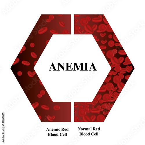 world hemophilia day red blood cell Iron deficiency anemia difference of Anemia amount of and normal symptoms vector illustration medical.
