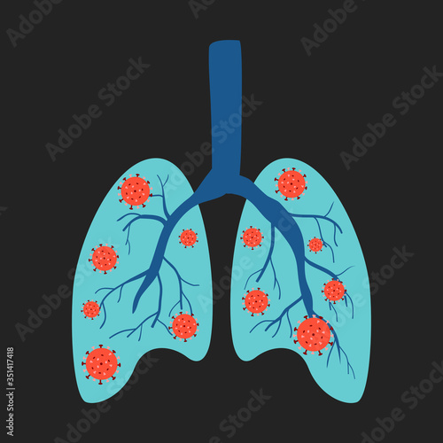 Vector illustration of lung infected with coronavirus.