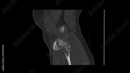CT Scan knee of the patient periarticular injuries fracture of the proximal tibia frequently associated with soft tissue injuries.Medical footage concept. photo