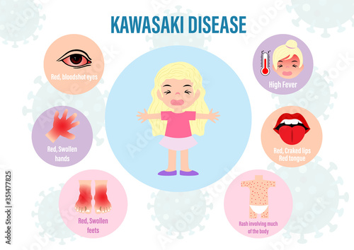 Picture info graphic of KAWASAKI disease in child with cartoon character and lettering on virus symbols and white background. Medical's poster of the Kawasaki disease in vector design.