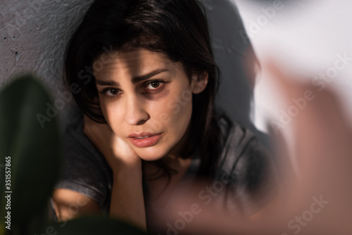 selective focus of depressed woman with bruise on face looking at camera near plant, domestic violence concept © LIGHTFIELD STUDIOS