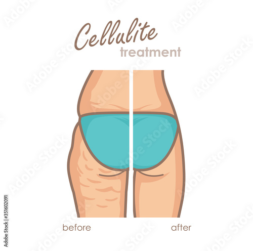 Cellulite treatment. Before and after losing weight. Vector illustration of female ass