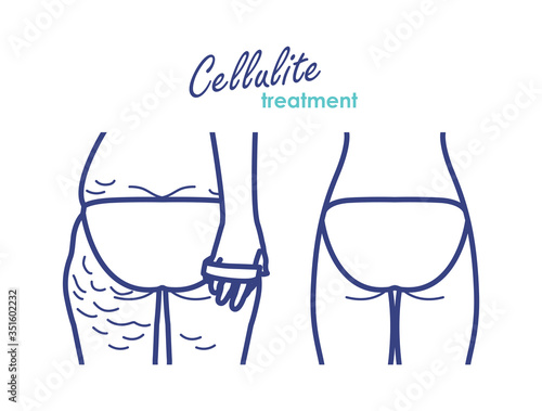 Reduce fat and cellulite at buttock. Vector line Illustration about body care