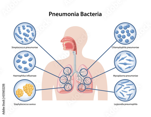 Page template with image of human body and Pneumonia bacteria in magnifying glass. Microbiology. Medical vector illustration in flat style in flat style over white background