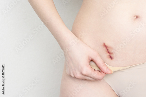 Wallpaper Mural Woman showing on her belly dark scar from a appendix, closeup. Healthcare concept Torontodigital.ca