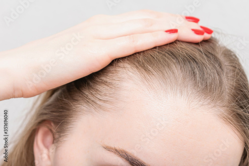 Girl shows on hair, close up. Concept of hair loss treatment