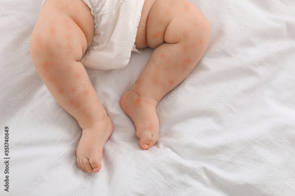 Little child with red rash on bed, top view. Baby allergies Little child with red rash on bed, top view. Baby allergies