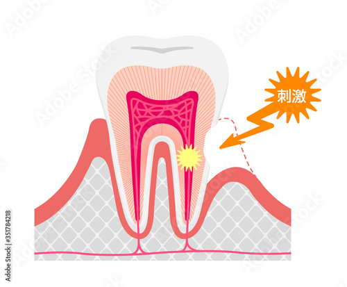 Cause and mechanism of Sensitive teeth vector illustration / Japanese
