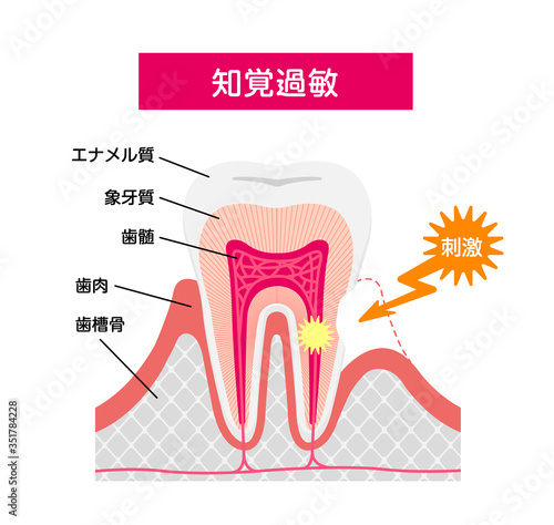Cause and mechanism of Sensitive teeth vector illustration / Japanese