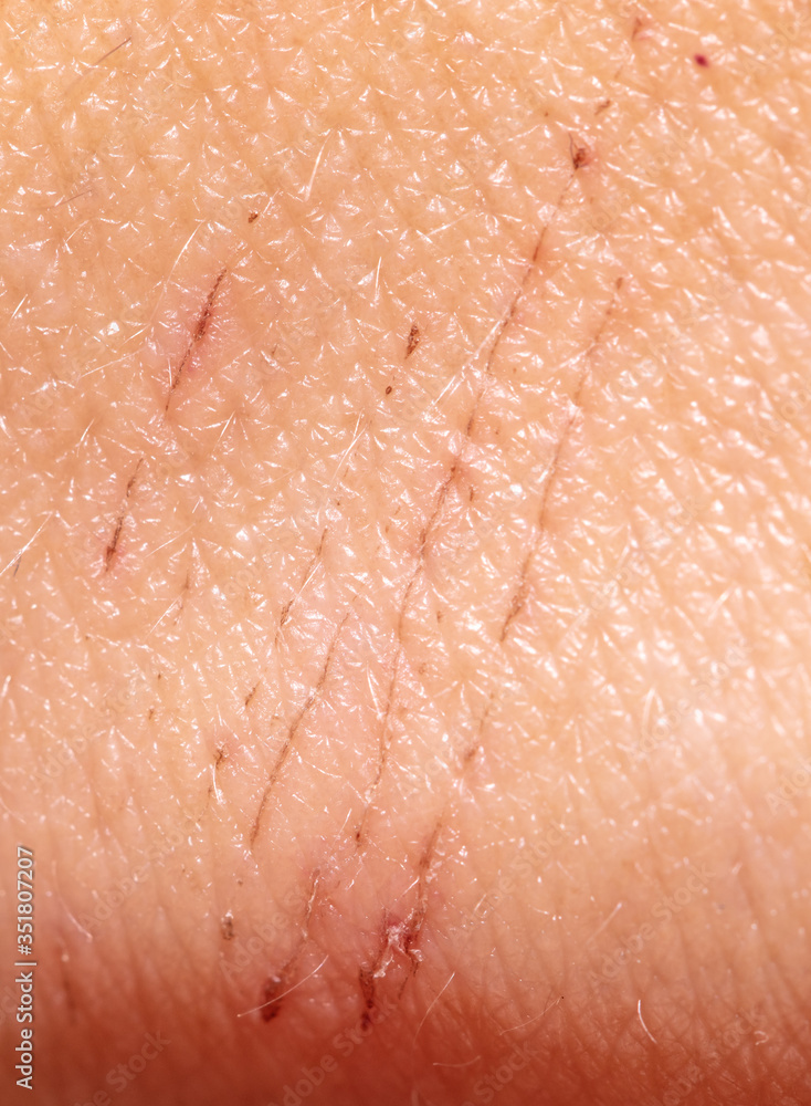 Fototapeta premium A wound on the skin of a person as a background.