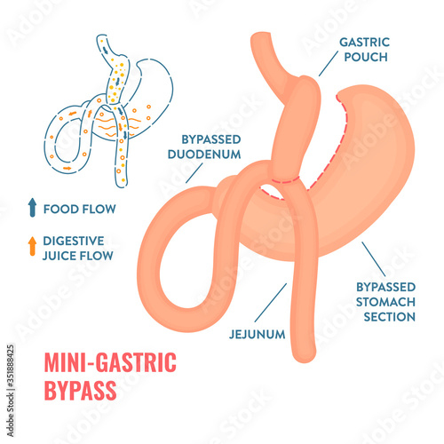 Mini gastric bypass. Bariatric surgery weight loss procedure. Stomach reduction anatomical diagram infographic. Health care  medical concept. Vector illustration.